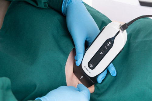 CHISON Sonotouch 30 Sonoeye Планшетный УЗИ сканер