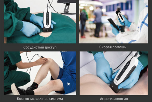 CHISON Sonotouch 30 Sonoeye Планшетный УЗИ сканер