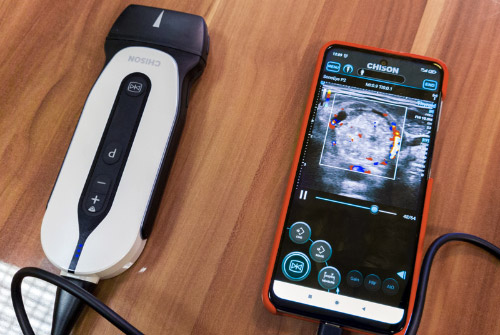CHISON Sonotouch 30 Sonoeye Планшетный УЗИ сканер
